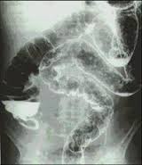 clisma-opaco