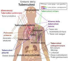 tubercolosi