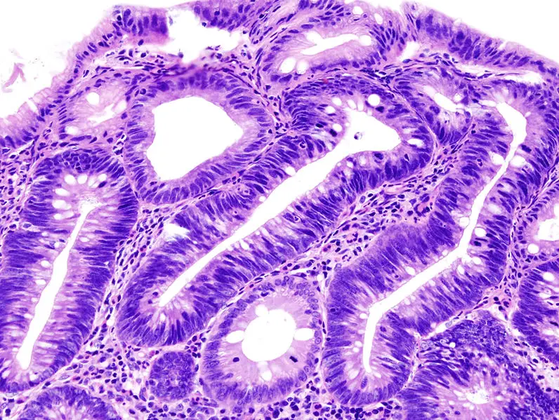 adenoma