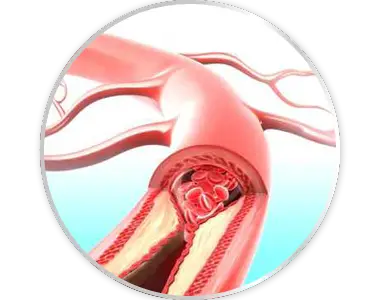 arterite
