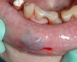 emangioma