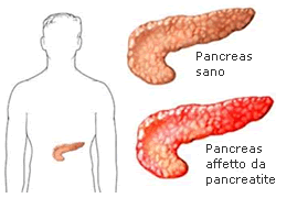 pancreatite-acuta