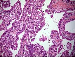 carcinoma-tiroideo-papillare