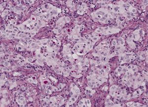 adenocarcinoma