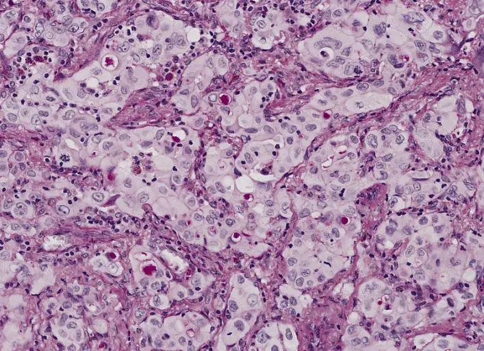 adenocarcinoma