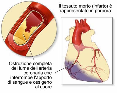 infarto-del-miocardio
