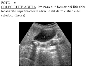 coleciste