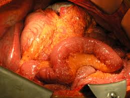 mucocele