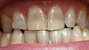 effetti tetraciclina sui denti