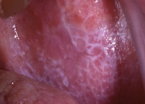 Lichen Planus