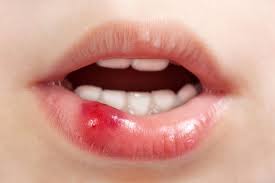 precancerosi-cutanea