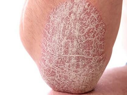 psoriasi1