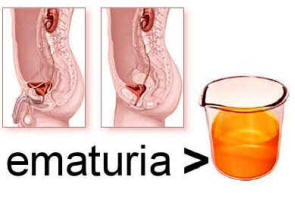 ematuria