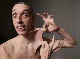 sindrome-di-Ehlers-Danlos
