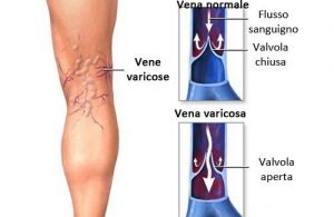 varici