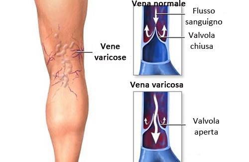 varici