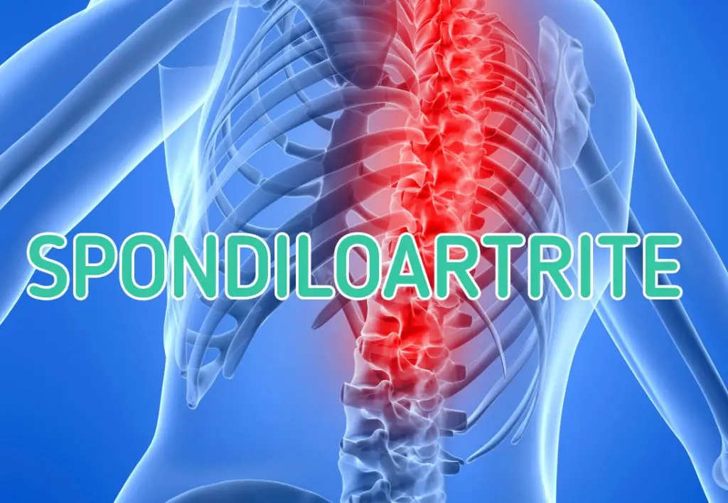 spondiloartrite