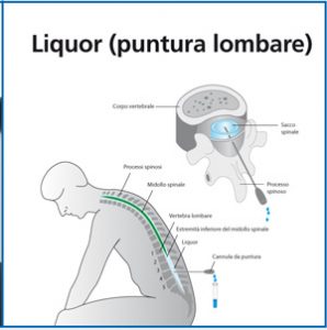 liquor-rachicentesi