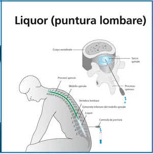 liquor-rachicentesi