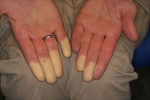 sclerosi-sistemica-raynaud1