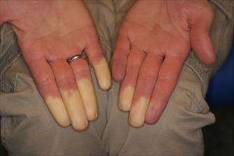sclerosi-sistemica-raynaud1