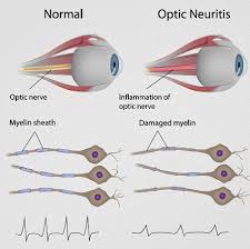 neuriti ottiche