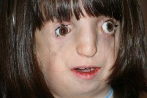Sindrome di Treacher-Collins