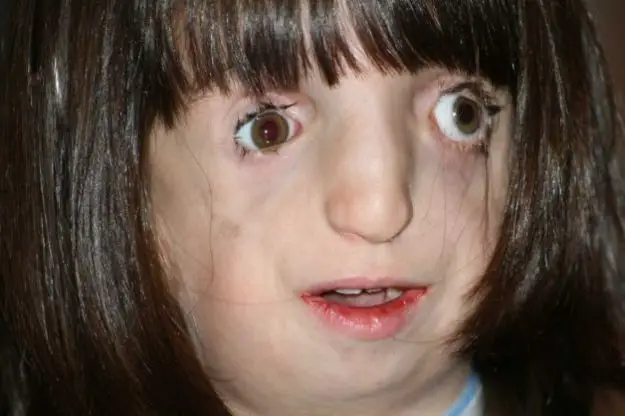 Sindrome di Treacher-Collins