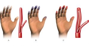 fenomeno-di-raynaud1