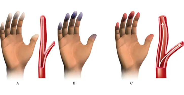 fenomeno-di-raynaud1