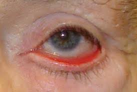 ectropion