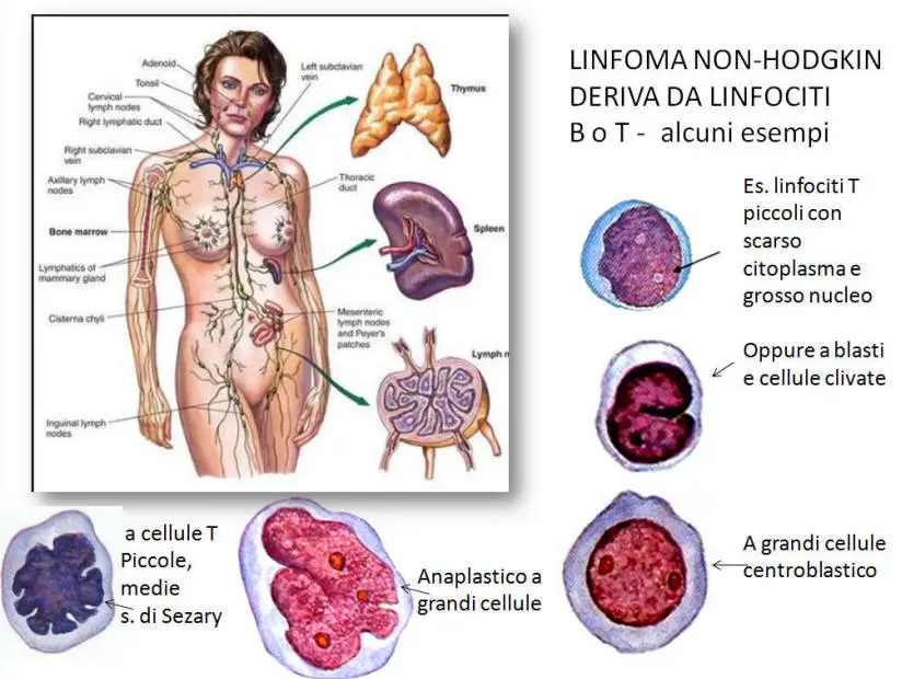 linfomi_non_hodgkin