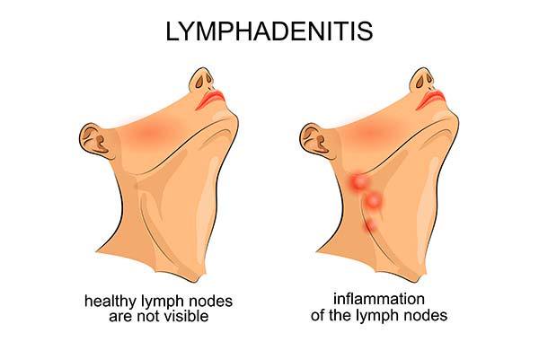 linfoadenopatia