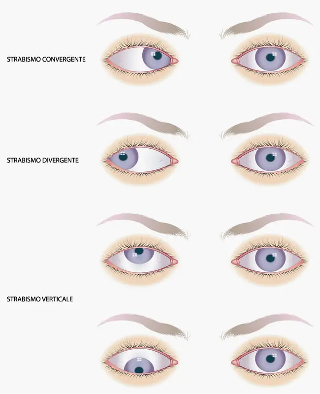 strabismo