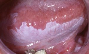 leucoplachie