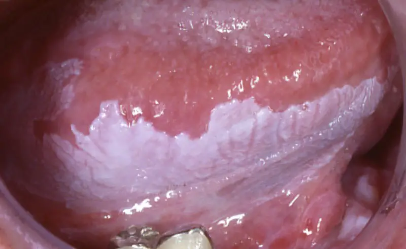 leucoplachie
