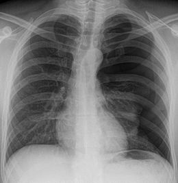 pneumotorace