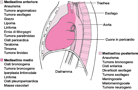 mediastino1