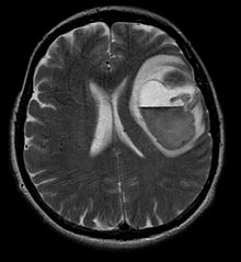 tumori-cerebrali