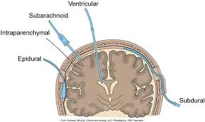 Pressione Intracranica