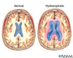 distacco-retina