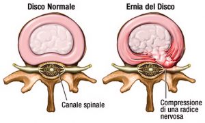 ernia_disco