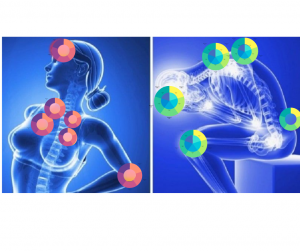 fibromialgia-tenderpoints